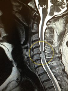 MRImyelopathy_before-WITH-CIRCLE-763x1024