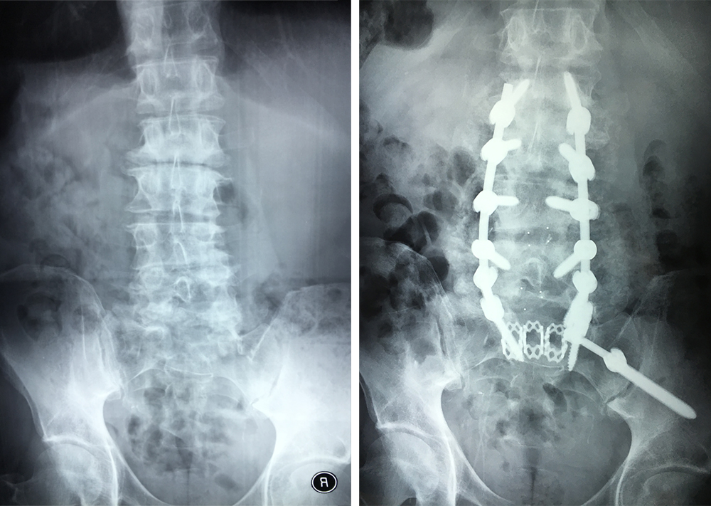 Multi-level Lumbar Fusion for Chronic Low Back Pain: Larry’s Patient Story